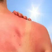 Tuviste la suerte de broncearte? Cinco tips sobre qu hacer y qu no ante las quemaduras del sol