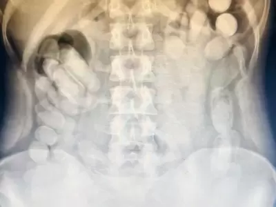 Detienen a una pasajera que haba ingerido ms de 100 cpsulas de cocana