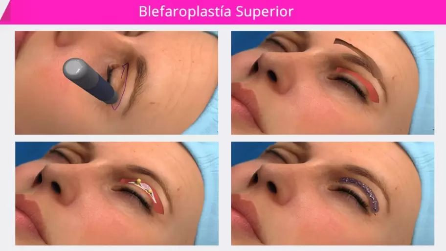 La China Surez se habra realizado una blefaroplastia
