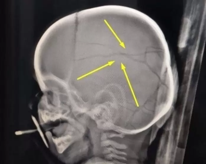 Un juez liber a un golpeador de nios y volvi a atacar: un beb de 11 meses con fractura de crneo