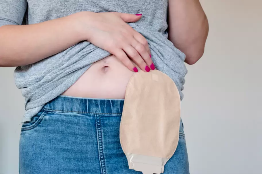 Las bolsas de colostomía son imprescindibles para muchos pacientes que atravesaron un cáncer de colon.