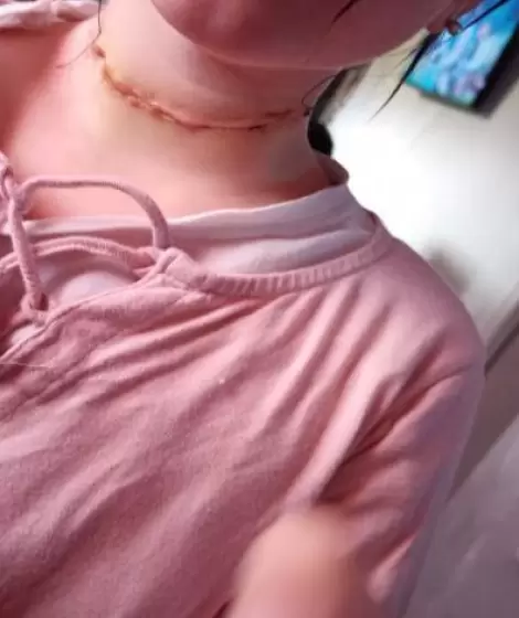 La menor con la herida en el cuello an cicatrizndose.