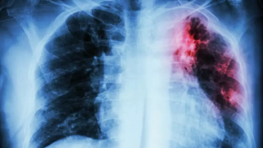 Alerta tuberculosis: se notificaron más de 13.000 casos en Argentina