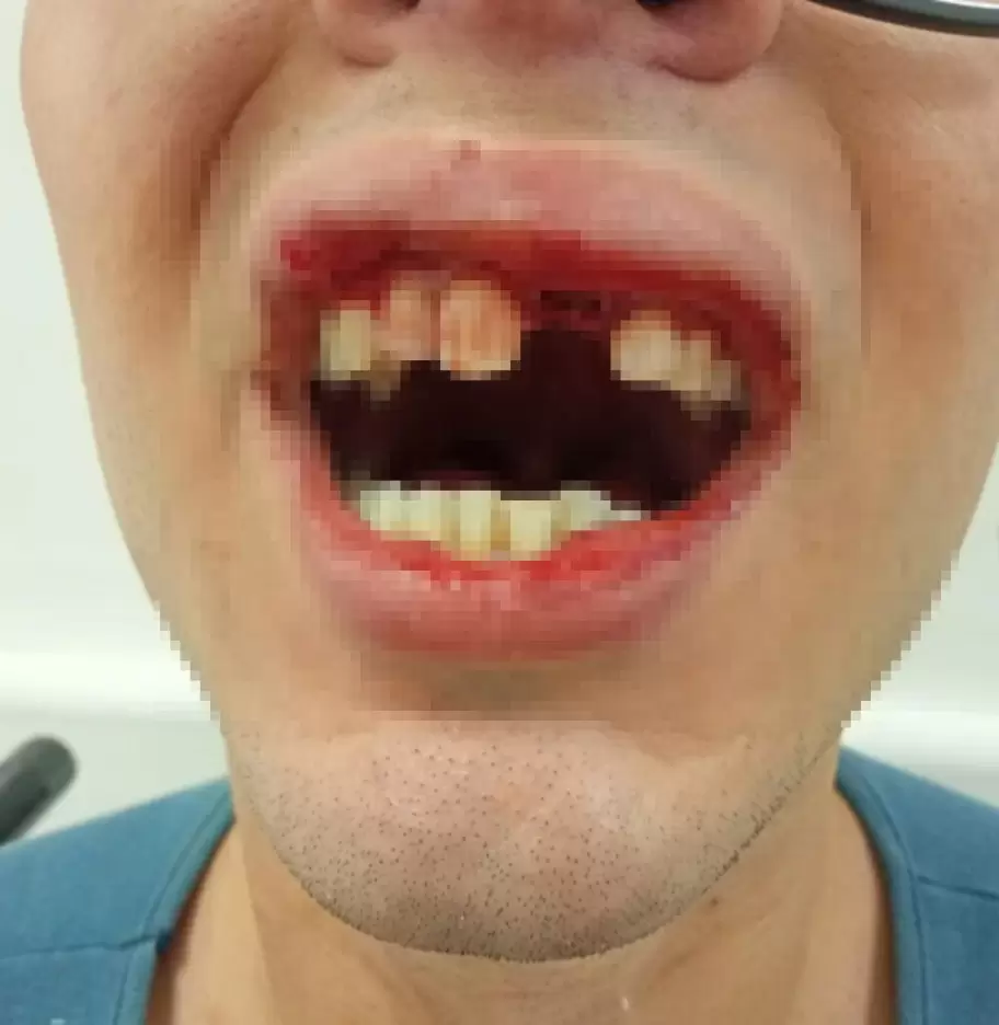 La Queen difundió cómo le quedó la boca tras el ataque homofóbico que sufrió en el barrio porteño de Villa Real