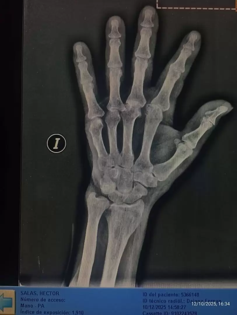 El diagn�stico m�dico posterior confirm� fracturas en la mano derecha