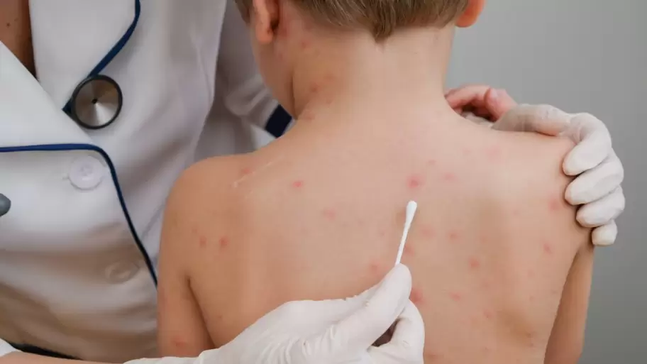 Alerta sanitaria: reaparece el sarampi�n