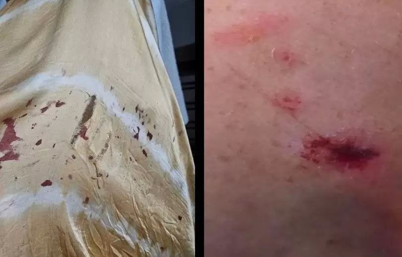 Andrea Taboada fue mordida en la playa