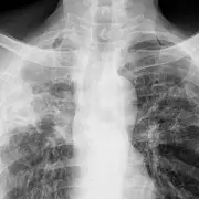 Preocupaci�n en Mar del Plata: se detect� un caso de tuberculosis en un alumno de sexto a�o