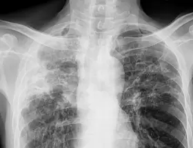 Detectaron un caso de tuberculosis en Mar del Plata