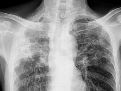 Detectaron un caso de tuberculosis en Mar del Plata
