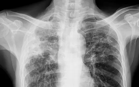 Detectaron un caso de tuberculosis en Mar del Plata