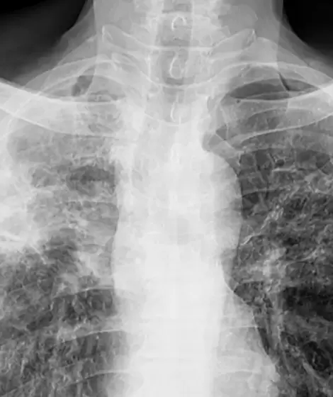 Detectaron un caso de tuberculosis en Mar del Plata