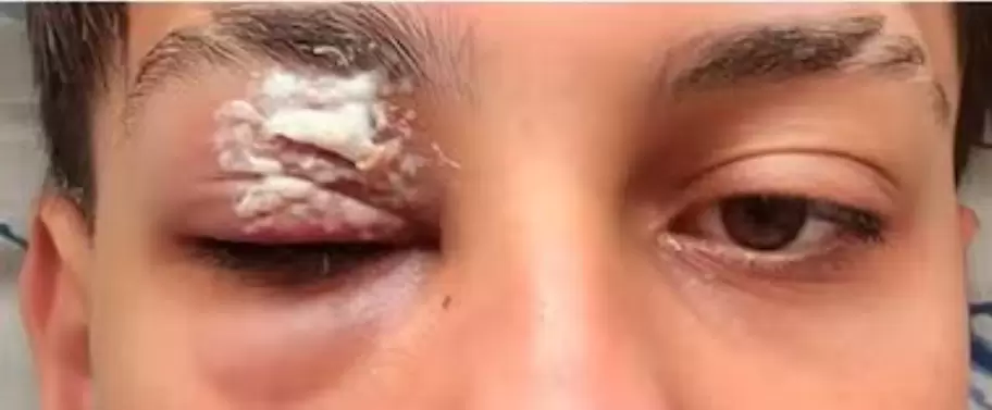 Así quedó el ojo de Julián Finoli tras la represión de la Policía de la Ciudad.