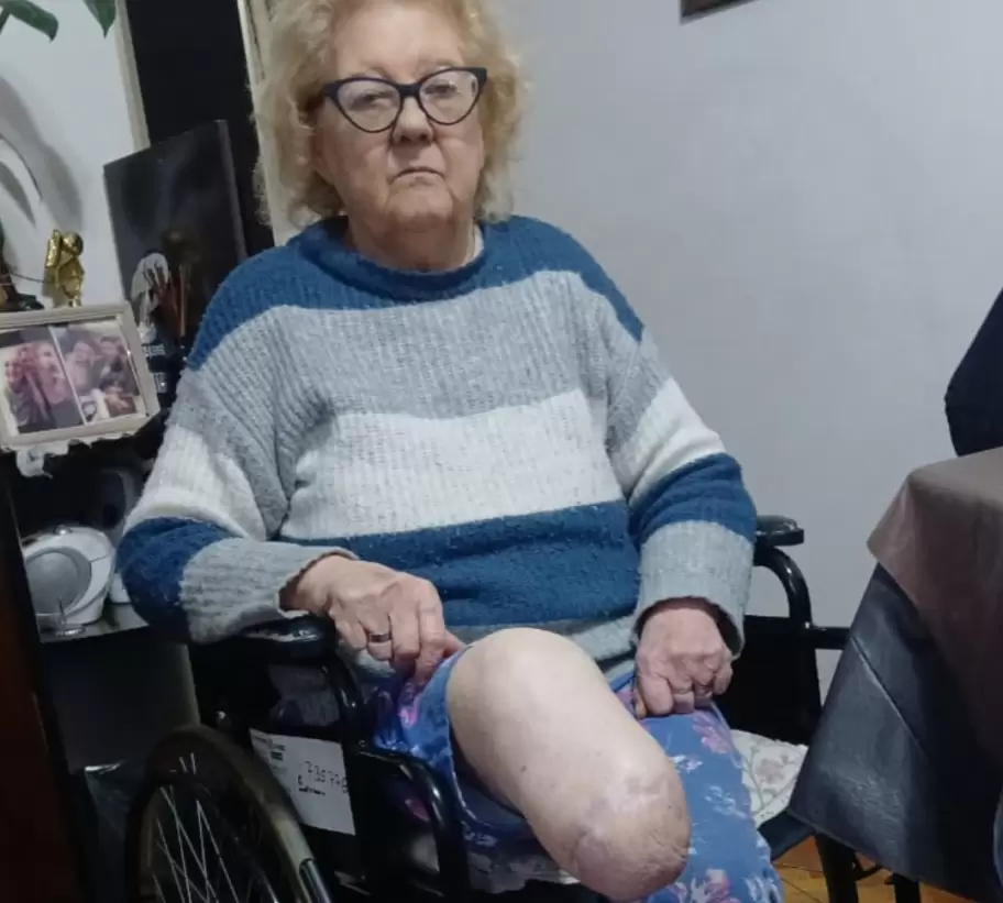 Juana Rosa Pereira muestra su pierna amputada que perdi� por una necrosis hace cinco a�os.