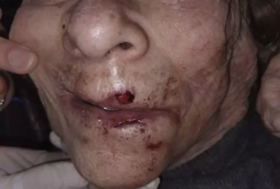 As� qued� la boca de la anciana agredida en el geri�trico "David" de Mar del Plata.