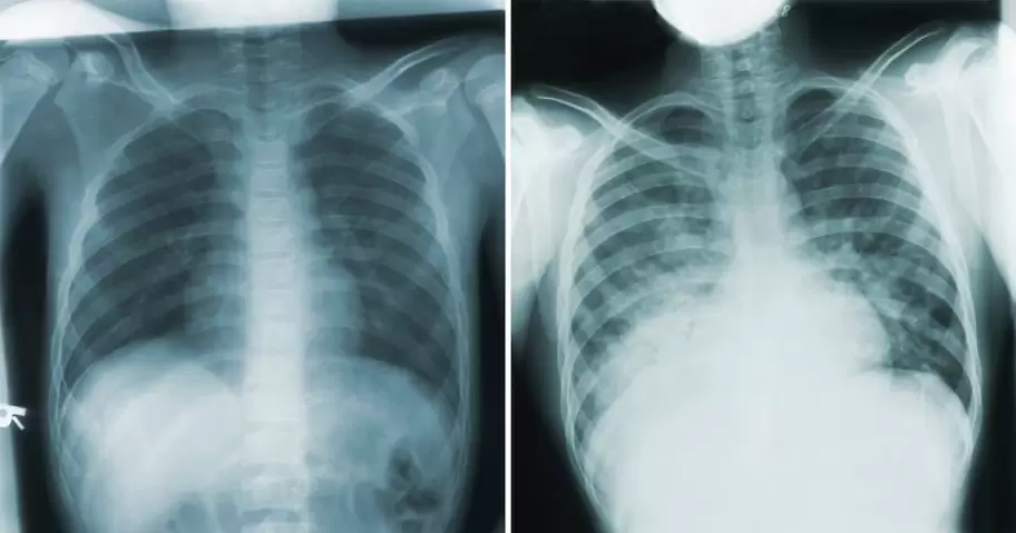 La peste neum�nica puede desarrollarse cuando una infecci�n existente en otra parte del cuerpo se extiende hasta los pulmones