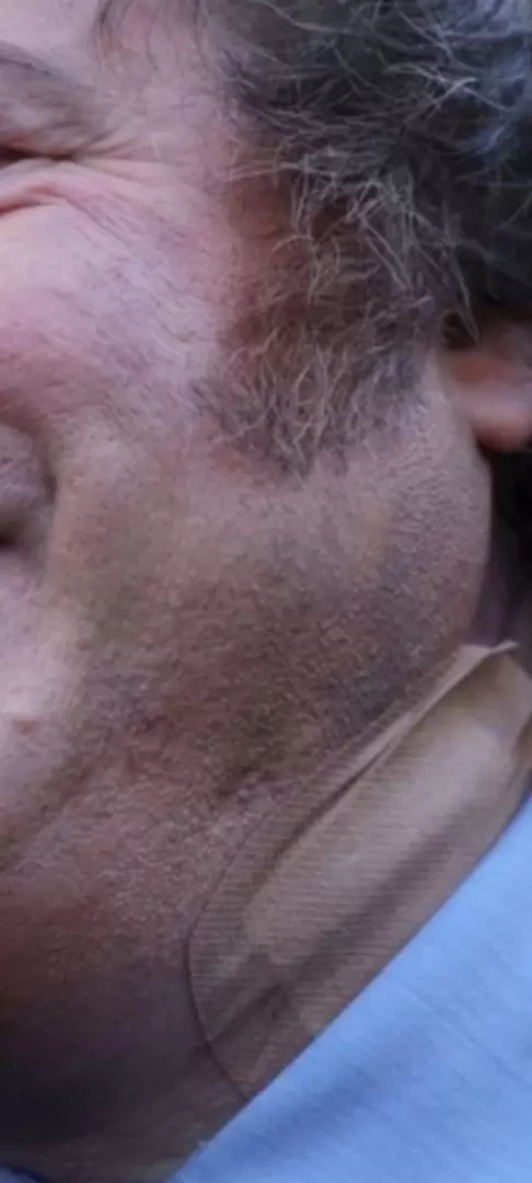Hematoma en la papada presidencial