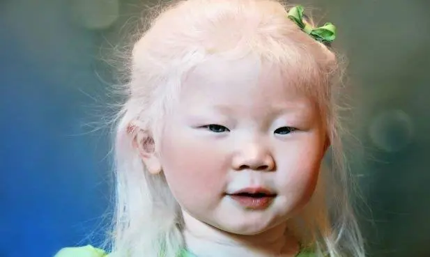 Albinos hay de todos orígenes.