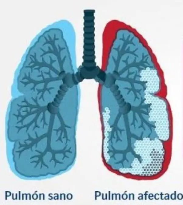 fibrosis pulmonar