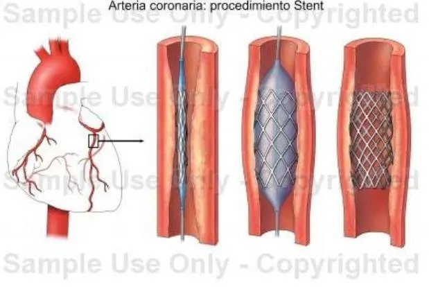 El procedimiento del stents