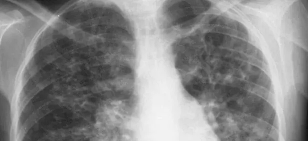 alt title fibrosis quistica
